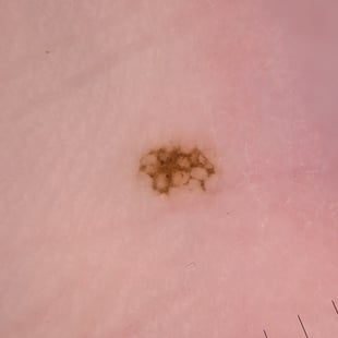 3 derm follow up