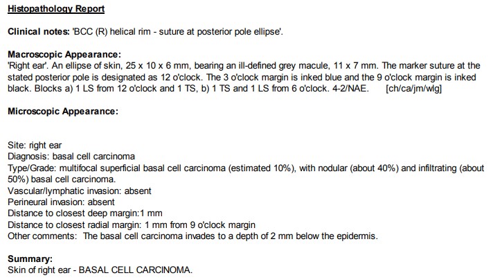 How would you manage this lesion on the helical rim?