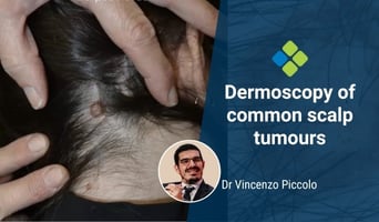 scalp lesions