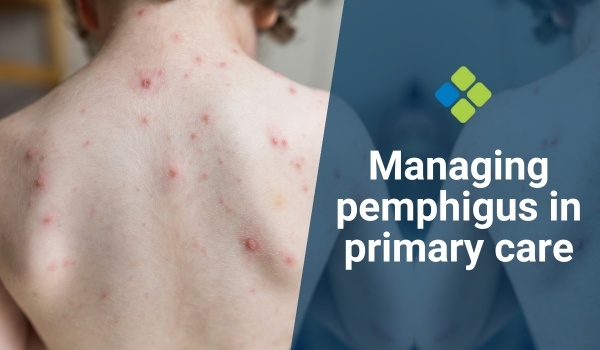 pemphigus