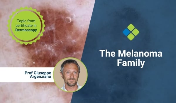 melanoma family