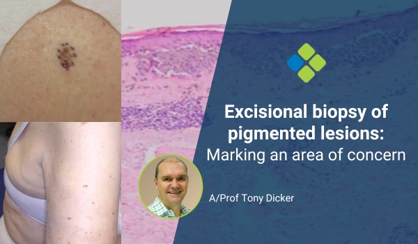 Excisional biopsy of pigmented lesions: Marking an area of concern