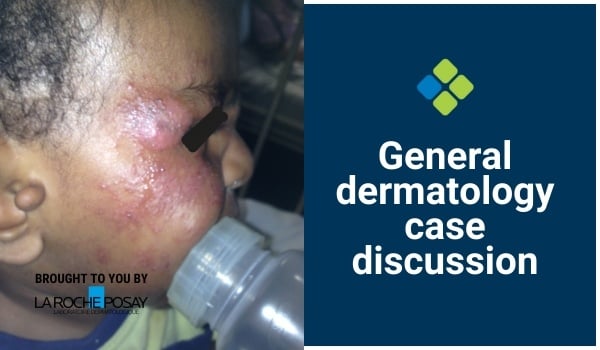 eczema case discussion