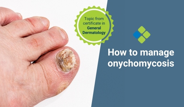 onychomycosis