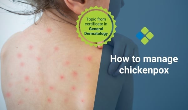 chickenpox