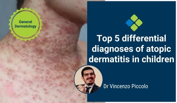 atopic dermatitis