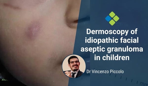 idiopathic facial aseptic granuloma